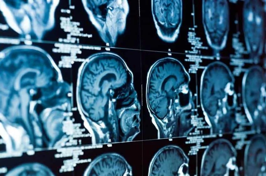Brain Injury